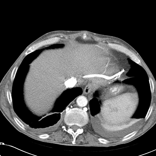 File:Obstructive superior vena cava tumor thrombus (Radiopaedia 28046-28306 A 46).jpg