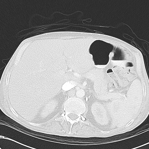 File:Obstructive superior vena cava tumor thrombus (Radiopaedia 28046-28306 Axial lung window 57).jpg