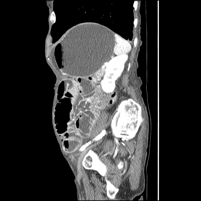 Obturator hernia causing small bowel obstruction (Radiopaedia 65522-74612 C 25).jpg