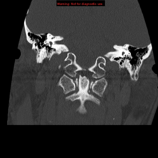File:Occipital condyle fracture (Radiopaedia 18366-18208 Coronal bone window 7).jpg