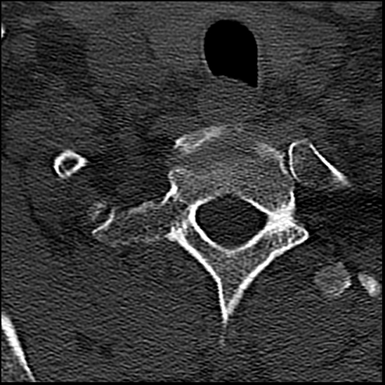 Occipital condyle fracture (type 1) (Radiopaedia 87670-104084 Axial bone window 84).jpg
