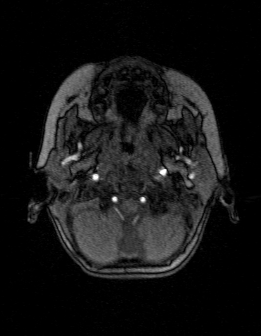 Occipital horn syndrome (Radiopaedia 14255-14129 MRA 16).jpg