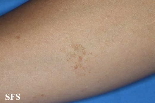 File:Syringoma (Dermatology Atlas 30).jpg