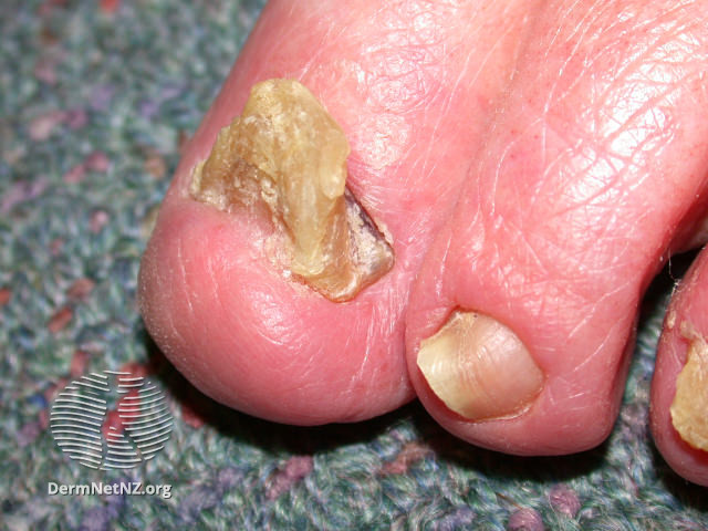 File:There have been a few reports ofcongenitalonychogryphosis, and onychogryphosis can be seen in a number of raregenodermatoses. (DermNet NZ onychogryphosis-04).jpg