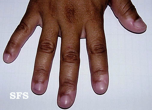 File:Vitiligo (Dermatology Atlas 10).jpg