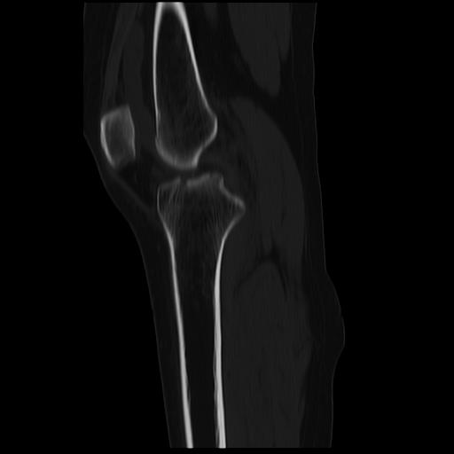 File:ACL avulsion fracture (Radiopaedia 33833-34994 Sagittal bone window 26).jpg