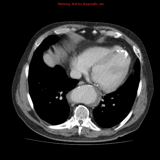 Abdominal aortic aneurysm (Radiopaedia 10122-10660 Axial C+ portal venous phase 3).jpg
