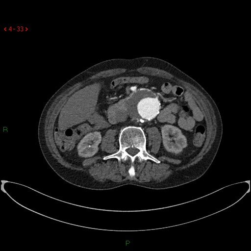 File:Abdominal aortic aneurysm (Radiopaedia 16155-15834 Axial C+ arterial phase 13).jpg