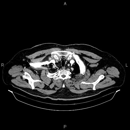 Abdominal aortic aneurysm (Radiopaedia 83094-97462 Axial renal cortical phase 9).jpg