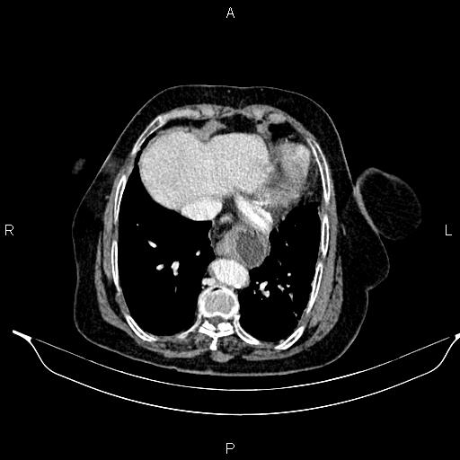 File:Abdominal aortic aneurysm (Radiopaedia 85063-100606 Axial C+ portal venous phase 25).jpg