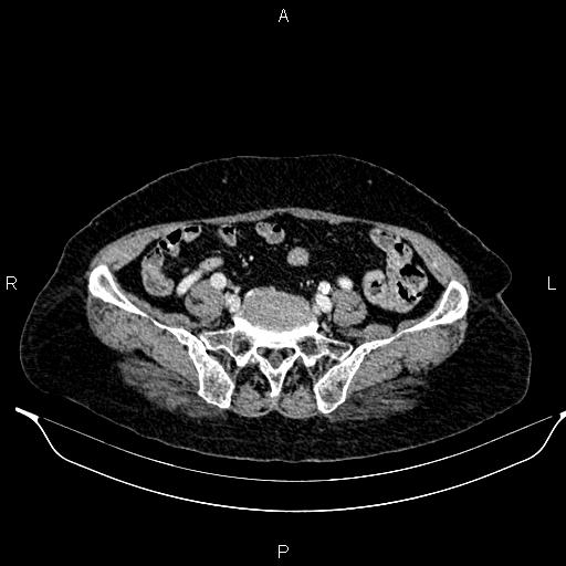 File:Abdominal aortic aneurysm (Radiopaedia 85063-100606 Axial C+ portal venous phase 53).jpg
