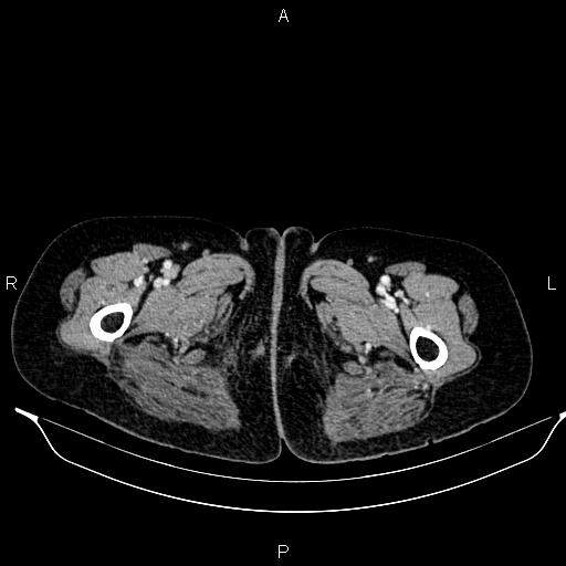 File:Abdominal aortic aneurysm (Radiopaedia 85063-100606 Axial C+ portal venous phase 73).jpg