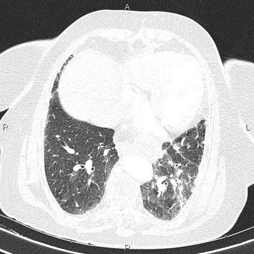 Abdominal aortic aneurysm (Radiopaedia 85063-100606 Axial lung window 46).jpg