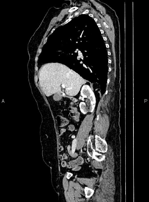 Abdominal aortic aneurysm (Radiopaedia 85063-100606 Sagittal C+ arterial phase 26).jpg