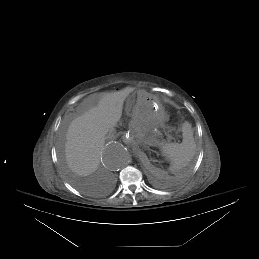 Abdominal aortic aneurysm - impending rupture (Radiopaedia 19233-19247 Axial non-contrast 39).jpg