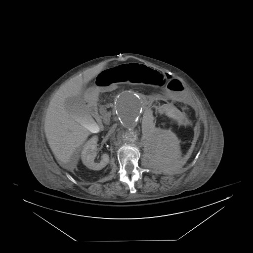 Abdominal aortic aneurysm - impending rupture (Radiopaedia 19233-19247 Axial non-contrast 74).jpg