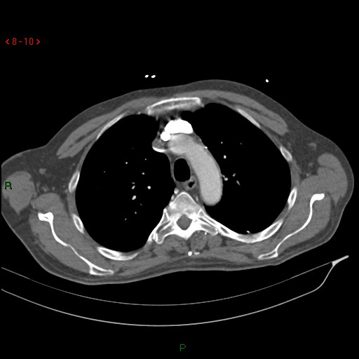 Abdominal aortic aneurysm rupture with aortocaval fistula (Radiopaedia 14897-14841 Axial C+ arterial phase 10).jpg
