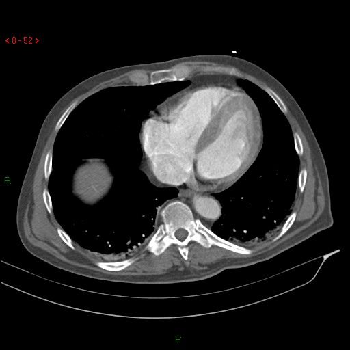 Abdominal aortic aneurysm rupture with aortocaval fistula (Radiopaedia 14897-14841 Axial C+ arterial phase 52).jpg
