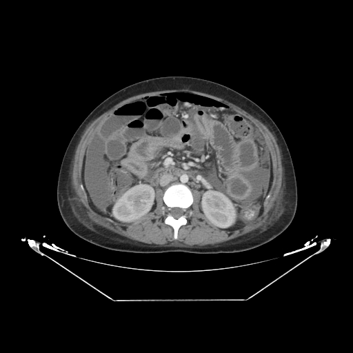 Abdominal gossypiboma- surgical towel (Radiopaedia 57288-64226 Axial C+ portal venous phase 29).jpg