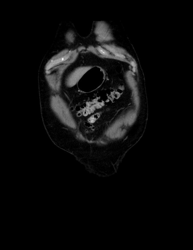 Abdominal lymphoma - with sandwich sign (Radiopaedia 53486-59492 C+ portal venous phase 54).jpg