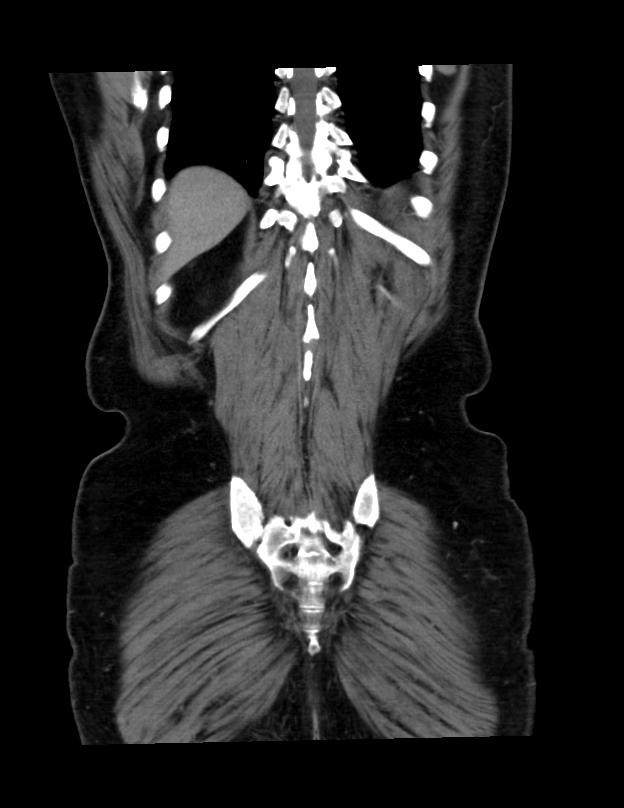 Abdominal lymphoma - with sandwich sign (Radiopaedia 53486-59492 C+ portal venous phase 7).jpg