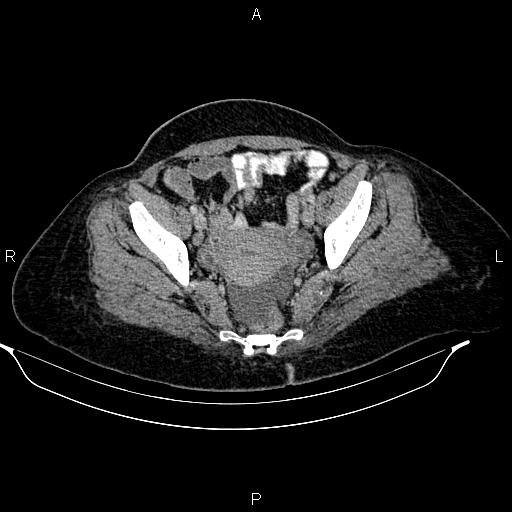 Abdominal lymphoma with sandwich sign (Radiopaedia 84378-99704 Axial C+ portal venous phase 49).jpg