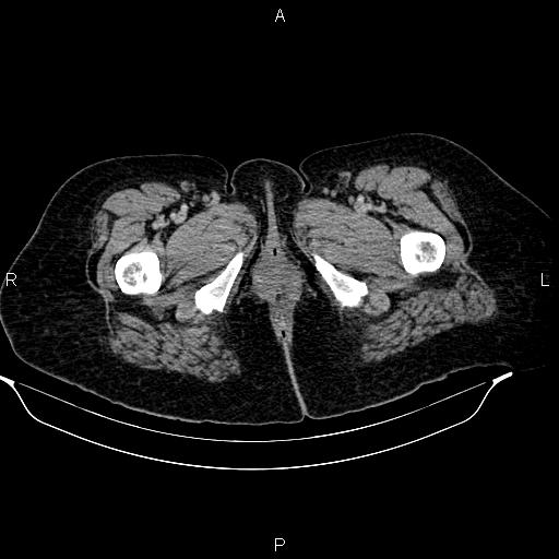 Abdominal lymphoma with sandwich sign (Radiopaedia 84378-99704 Axial C+ portal venous phase 63).jpg