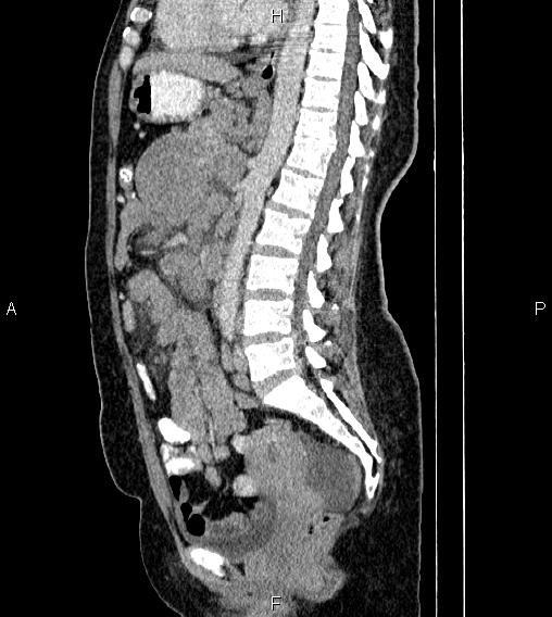 Abdominal lymphoma with sandwich sign (Radiopaedia 84378-99704 Sagittal C+ portal venous phase 47).jpg