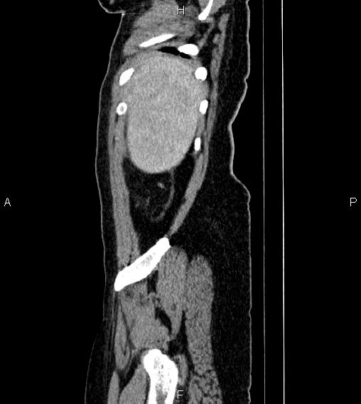 Abdominal lymphoma with sandwich sign (Radiopaedia 84378-99704 Sagittal C+ portal venous phase 87).jpg