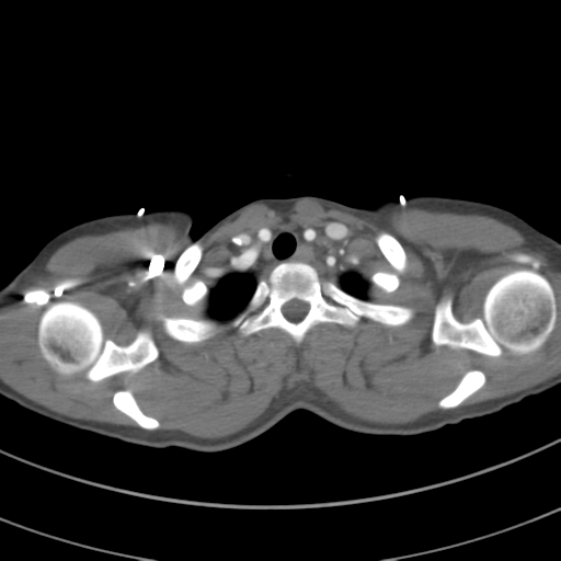 File:Abdominal multi-trauma - devascularised kidney and liver, spleen and pancreatic lacerations (Radiopaedia 34984-36486 Axial C+ arterial phase 11).png