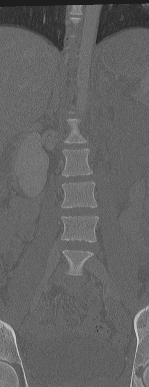 Abdominal multi-trauma - devascularised kidney and liver, spleen and pancreatic lacerations (Radiopaedia 34984-36486 Coronal bone window 19).png