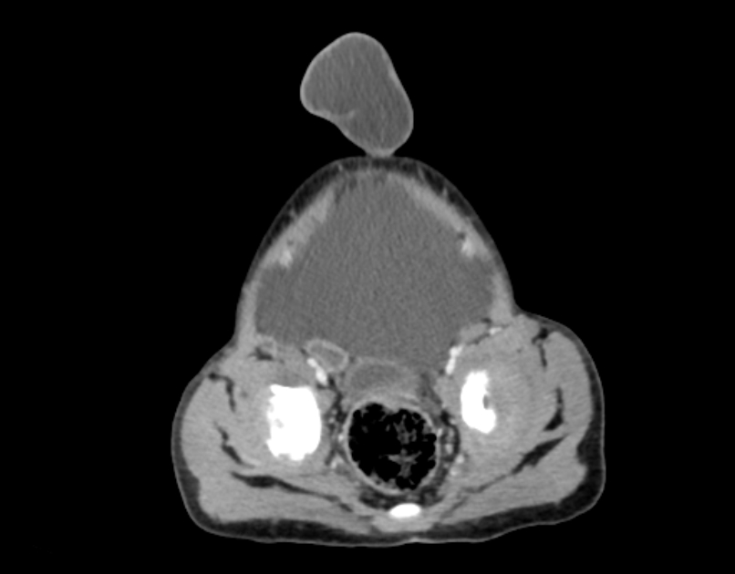 Abdominal premesenteric cystic lymphangioma (Radiopaedia 82995-97350 Axial C+ portal venous phase 59).jpg
