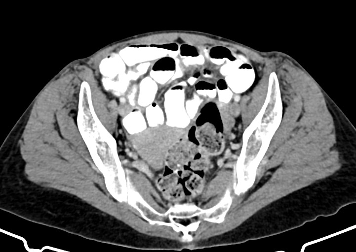 Abdominal wall and retroperitoneal tuberculosis (Radiopaedia 88137-104729 Axial C+ portal venous phase 156).jpg
