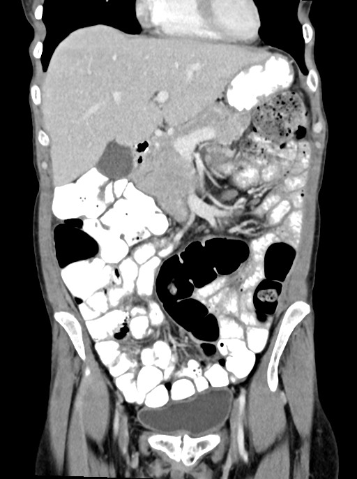 Abdominal wall and retroperitoneal tuberculosis (Radiopaedia 88137-104729 Coronal C+ portal venous phase 35).jpg