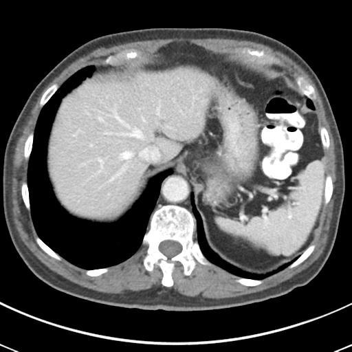 Abdominal wall metastasis from colorectal carcinoma (Radiopaedia 31016-31717 Axial C+ portal venous phase 16).jpg