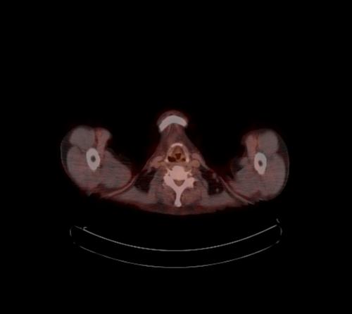 Abdominal wall metastasis from colorectal carcinoma (Radiopaedia 31016-31719 C 135).jpg