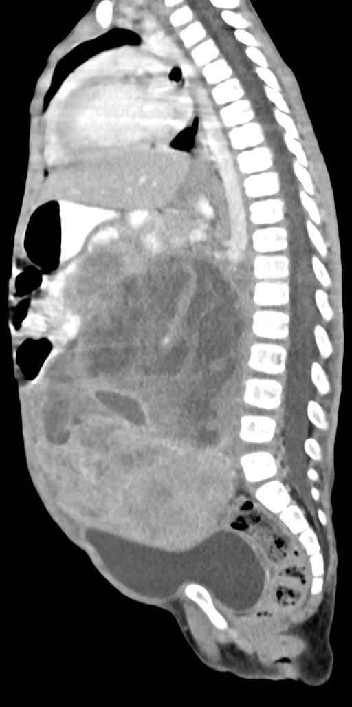 Abdominopelvic rhabdomyosarcoma (Radiopaedia 78356-90984 Sagittal C+ portal venous phase 44).jpg