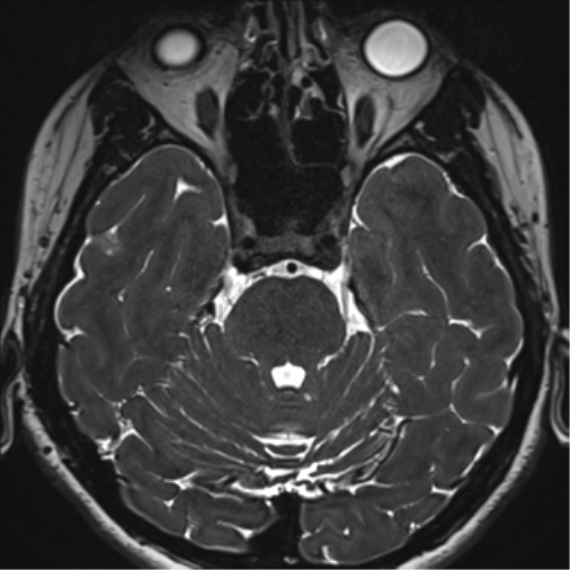 Abducens nerve palsy (Radiopaedia 51069-56648 Axial T2 fat sat 41).png