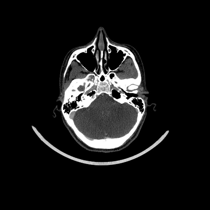 Aberrant right internal carotid artery (Radiopaedia 65191-74197 Axial C+ arterial phase 41).jpg