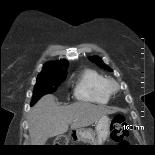 Aberrant right subclavian artery stenosis (Radiopaedia 52656-58670 B 23).jpg