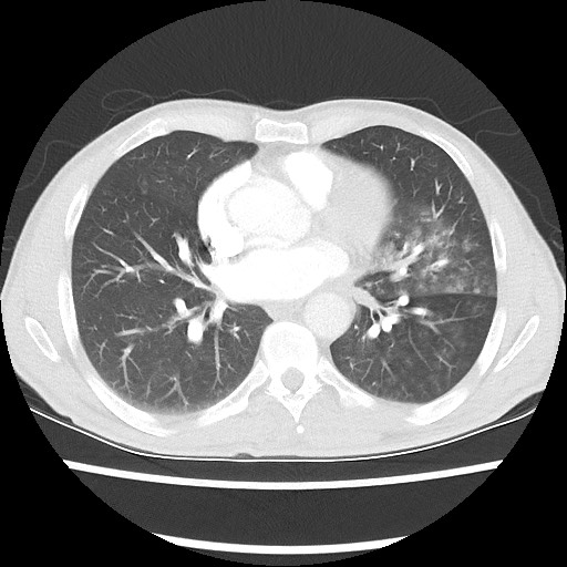 Accessory left horizontal fissure with lingular pneumonia (Radiopaedia 53763-59843 Axial lung window 33).jpg
