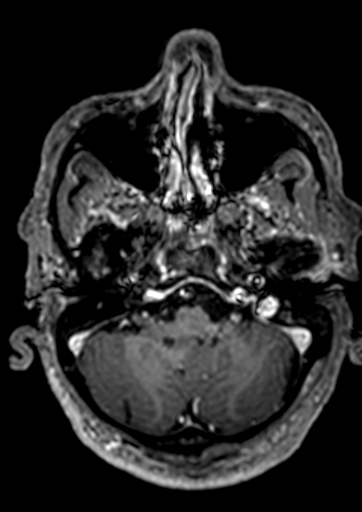 Accessory middle cerebral artery (Radiopaedia 73114-83828 Axial T1 C+ 145).jpg