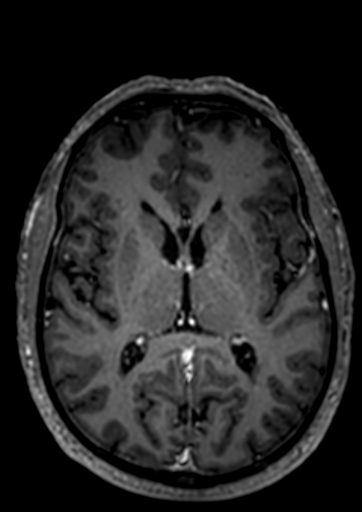 File:Accessory middle cerebral artery (Radiopaedia 73114-83828 Axial T1 C+ 22).jpg