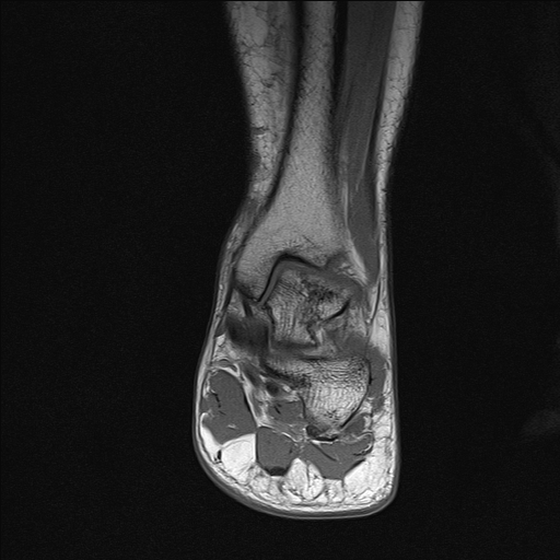File:Achilles tendon tear (Radiopaedia 77615-89819 Coronal T1 14).jpg