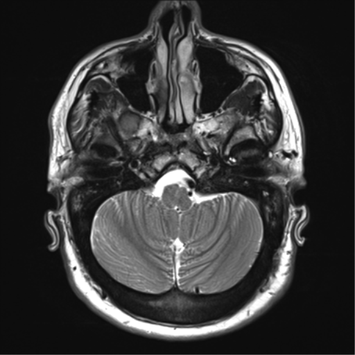 File:Achondroplasia (Radiopaedia 65109-74105 Axial T2 5).png