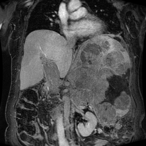 Acinar cell carcinoma of the pancreas (Radiopaedia 75442-86668 Coronal T1 C+ fat sat 103).jpg