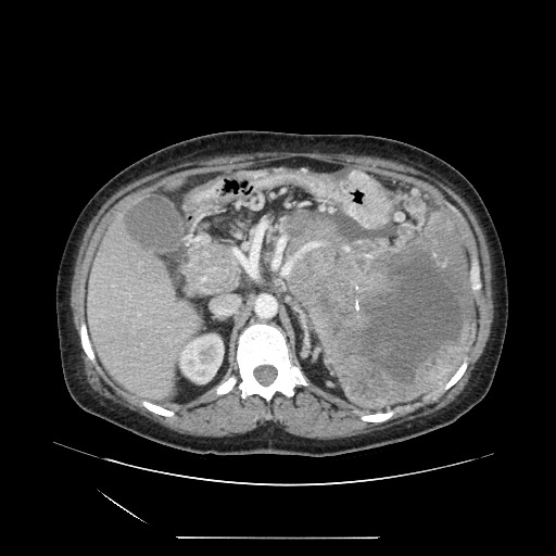 File:Acinar cell carcinoma of the pancreas (Radiopaedia 75442-86669 Axial C+ portal venous phase 45).jpg
