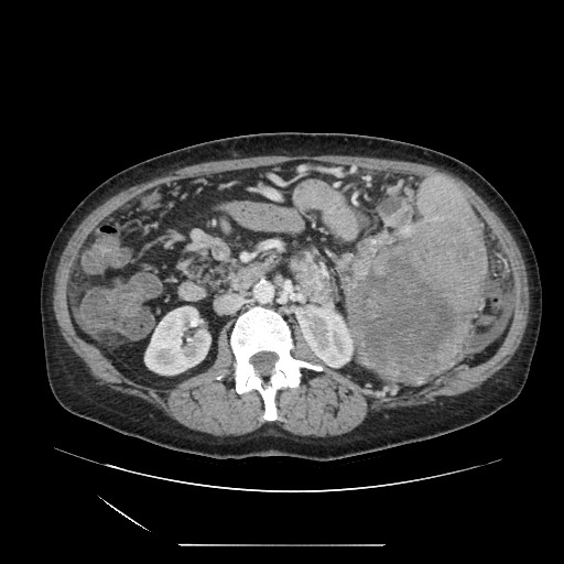 Acinar cell carcinoma of the pancreas (Radiopaedia 75442-86669 Axial C+ portal venous phase 63).jpg