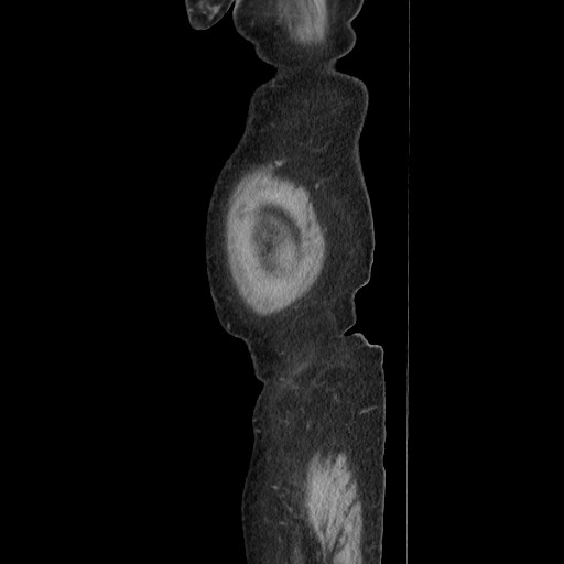 Acinar cell carcinoma of the pancreas (Radiopaedia 75442-86669 Sagittal C+ portal venous phase 23).jpg