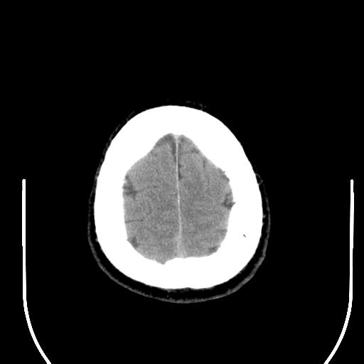 File:Acoustic schwannoma (Radiopaedia 29488-29982 AXIAL THICK non-contrast 44).jpg